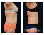 Liposuction