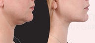 38 year old woman jawline and neck liposuction