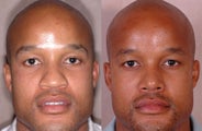 Rhinoplasty