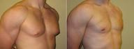 Male Breast Reduction