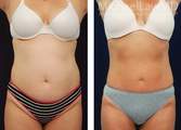 Liposuction