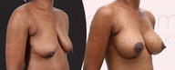 Breast lift and breast implants after breast deflation