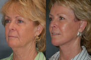 Facelift