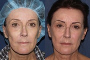 Sculptra Before and After