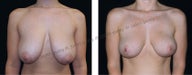 Breast Lift