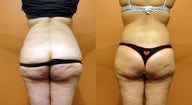 Body Lift