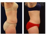 Liposuction
