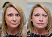 Female treated for nasolabial folds