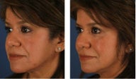 Dermal Fillers for Non-Surgical Cheek Enhancement