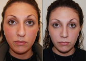 Rhinoplasty, frontal view