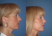 Revision Nasal Surgery