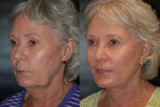 Facelift
