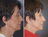 Facelift