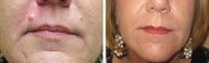 Mole Removal photos