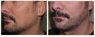 Facial hair transplant