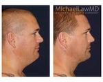 Liposuction