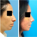 32 Year Old Female Nose Surgery