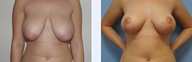 24 Year Old Female Breast Uplift Patient
