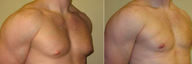 Male Breast Reduction