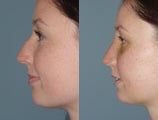Female Patient Primary Rhinoplasty