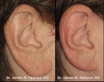 Earlobe Reduction