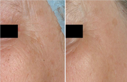 Before and after Non Ablative No Down Time Laser Wrinkle Removal