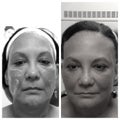 Sculptra before and immediately after (stay tuned for follow up because this LASTS)