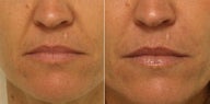Smile lines treated with Restylane