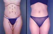 Tumescent Liposuction