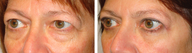 Female Blepharoplasty