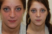 Rhinoplasty Surgery. 6 months post-op.