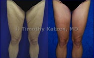 Thigh Lift after massive weight loss