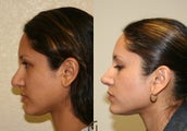 Revision Rhinoplasty