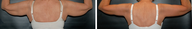 Arm Lift