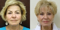 72 year old desired minimal facelift and eyelid lift