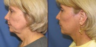 Short scar facelift
