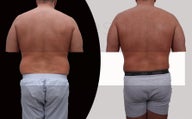 Male liposuction with body-jet ( water liposuction) for "love-handles"