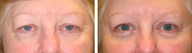 Female Blepharoplasty