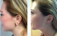25 yo Stretched Earlobe Repair