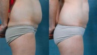 CoolSculpting Results