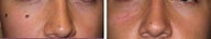 Mole Removal photos