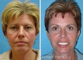 Blepharoplasty and Facelift