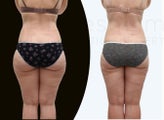 37 year old women body jet liposuction to remove fat and shaping of thighs