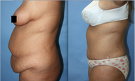 Abdominoplasty
