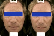 50 Year Old Male treated for Age Spots
