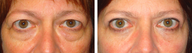 Female Blepharoplasty
