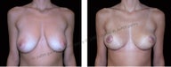 Breast Lift