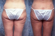 Tumescent body liposuction