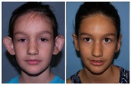 Otoplasty