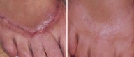 Before and After 1540 Laser Treatment of Hypertrophic Scar